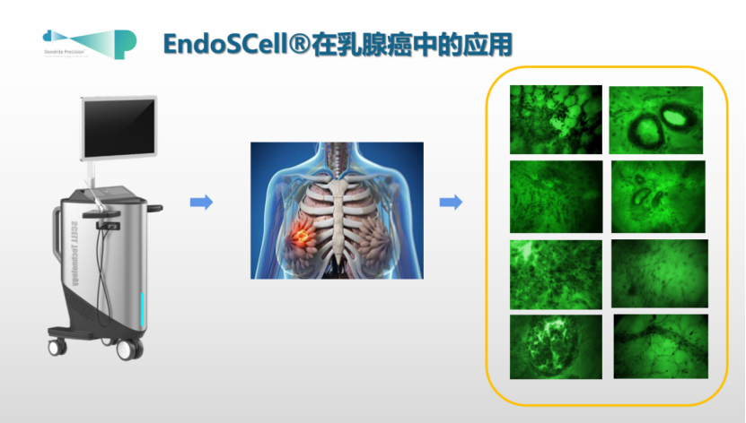 天津國(guó)際乳腺癌大會(huì)專(zhuān)家銳評(píng)：EndoSCell?細(xì)胞級(jí)精準(zhǔn)手術(shù)有助提高保乳率(圖3)