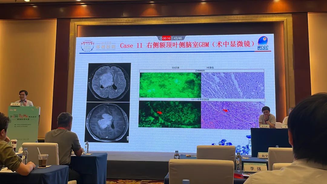 1200倍+放大直視腫瘤細(xì)胞！全球首創(chuàng)細(xì)胞級熒光導(dǎo)引技術(shù)EndoSCell?亮相華西神外學(xué)術(shù)周(圖5)